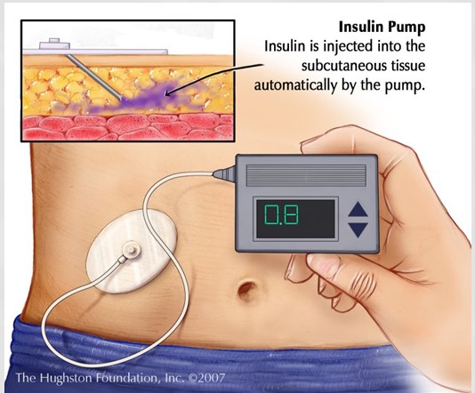 Insulin Pumps - of things
